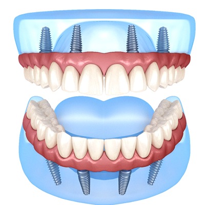 All-on-4 dental implants in Springfield for upper and lower arches