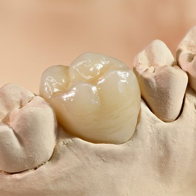 Model smile with dental crown restoration