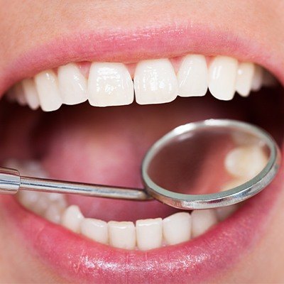 Closeup of smile with tooth-colored fillings