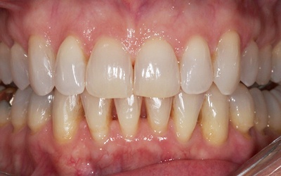 Flawless smile after treatment