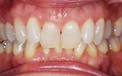 Uneven smile before treatment