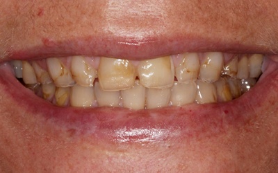 Damaged teeth before treatment