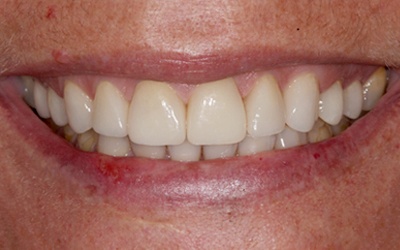 Beautiful smile after dental crown restoration