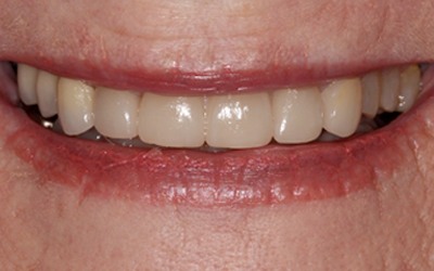 Beautiful smile after veneers and brdige tooth replacement