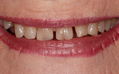 Damaged and unevenly spaced teeth