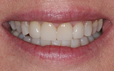 Gorgeous smile after porcelain veneers