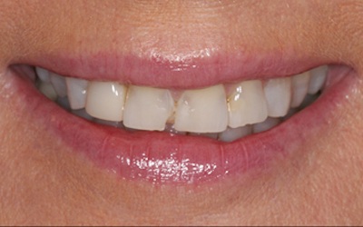 Discolored smile before treatment