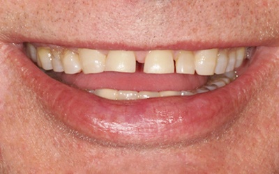 Damagd smile with gap between front teeth