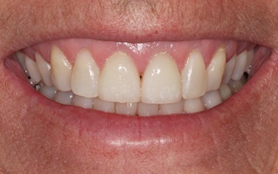 Flawless smile after porcelain veneer placement