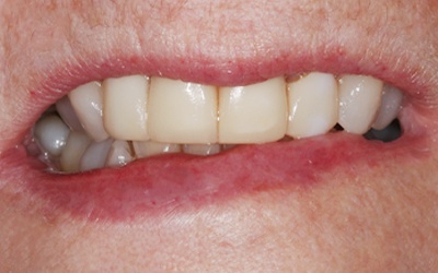 Unnatrual looking dental restorations