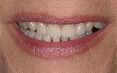 Beautiful smile after porcelain veneer placement