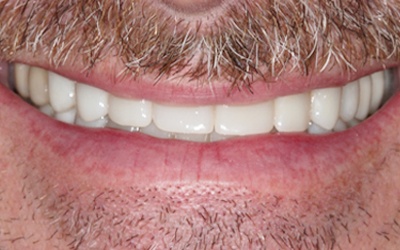 Perfect smile after dental crown placement