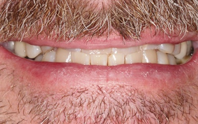 Severely worn top teeth