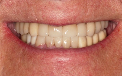 Beautiful smile after dental crowns and implant tooth replacement