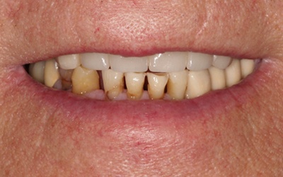 Badly damaged bottom teeth