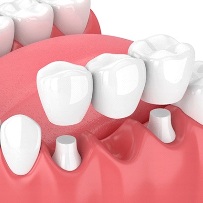 Animated smile during dental bridge placement