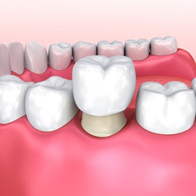 Animated smile during dental crown placement