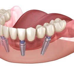 Implant dentures on white background