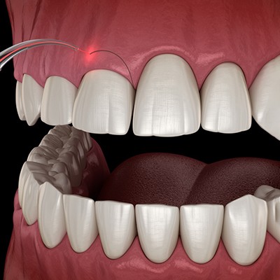 Illustration of soft tissue laser being used during gum recontouring