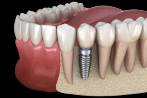 Animation of implant supported dental crown