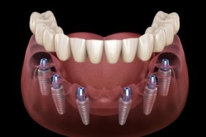 Animation of implant supported denture