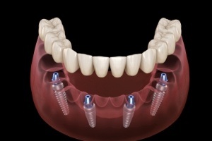 Animation of All-on-4 denture