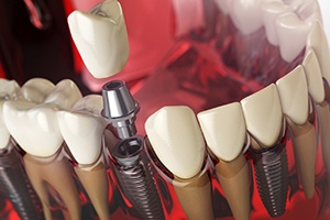 Implant, abutment, crown; multiple dental implants in Springfield, MO