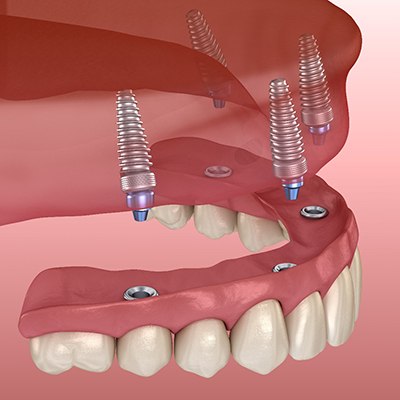 Animated implant dentures