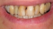 Closeup of patient's damaged and decayed smile