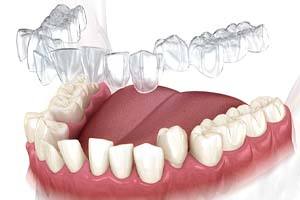 Animated smile with crooked teeth during Invisalign tray placement