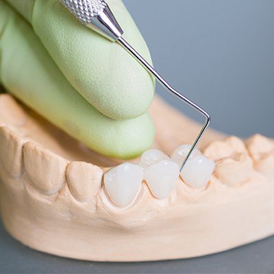 Model smile with fixed bridge restoration