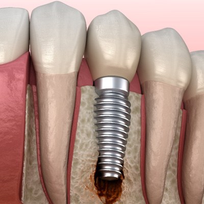 Illustration of a failed dental implant in Springfield, MO