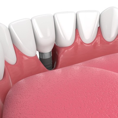 Illustration of a dental implant that failed due to gum disease