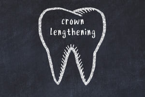 Drawing of tooth with the words “crown lengthening”